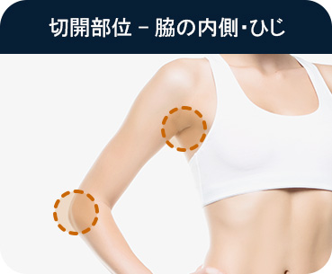 바디 지방흡입 절개부위 겨드랑이 안쪽 팔꿈치
