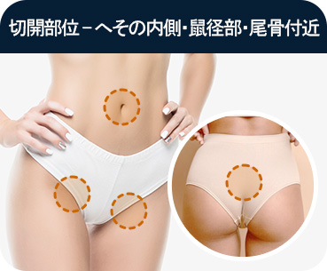 바디 지방흡입 절개부위 배꼽안쪽 팬티라인 꼬리뼈
