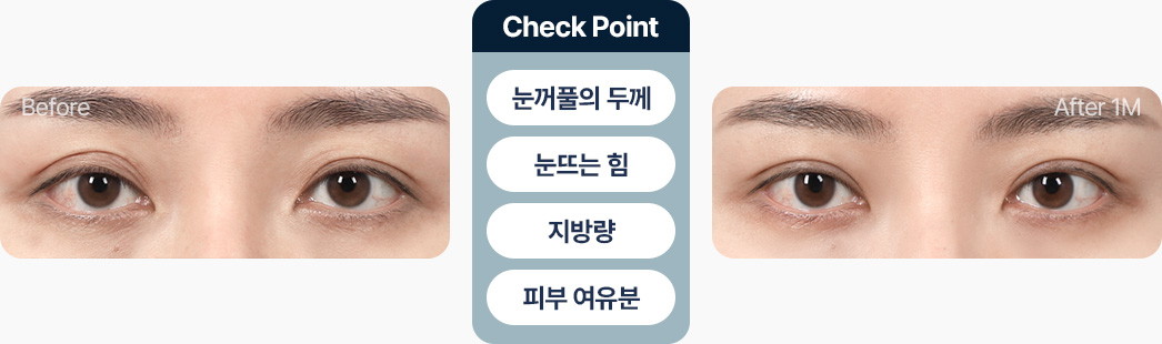 원더풀 라인낮추기 두줄따기 눈꺼풀 두께 눈뜨는 힘 지방량 피부 여유분