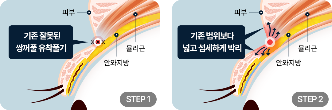 조직손상 최소화 기존 잘못된 쌍꺼풀 유착풁기 기존 범위보다 넓고 섬세하게 박리
