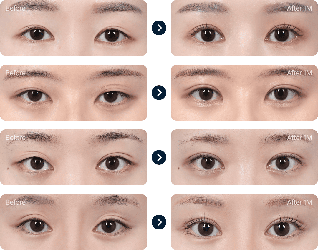 눈재수술 전후사진