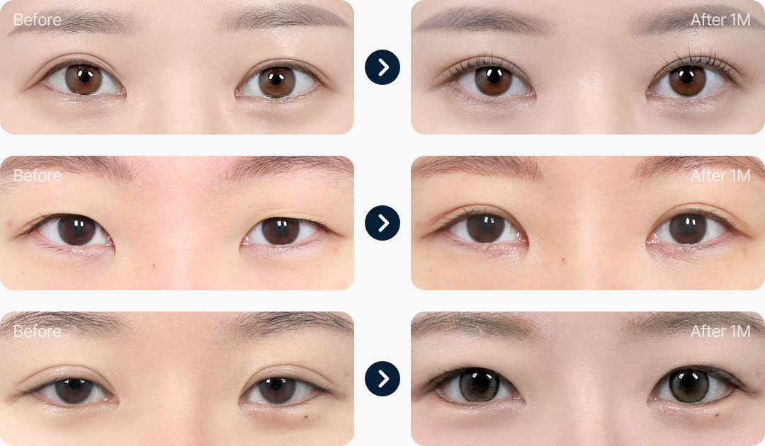 라인낮추기 전후사진