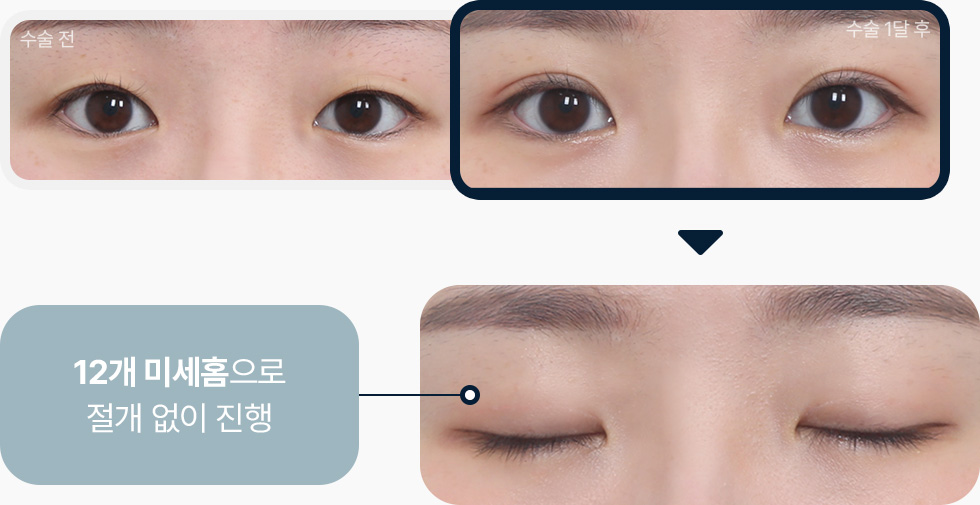 원더풀 자연유착 비절개 12개 미세홈 자연유착리뷰 자연유착전후사진