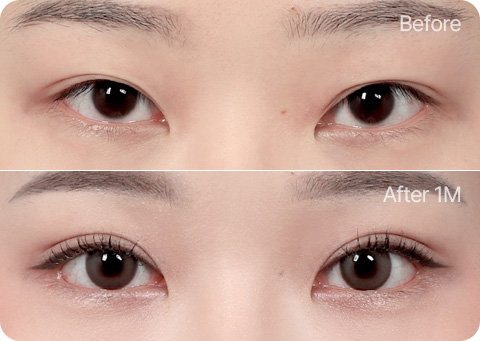 원더풀 부분절개 눈재수술 윗트임 눈매교정 뒤밑트임