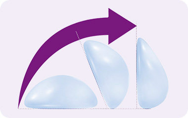 모티바 보형물 자연스러움