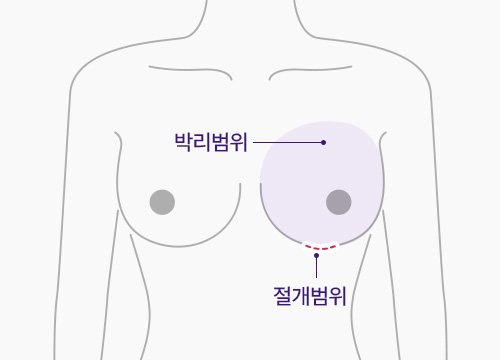 가슴밑선 절개