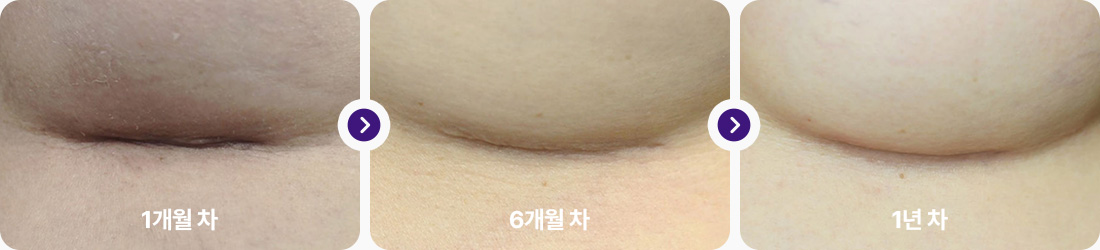가슴밑선 절개 후기 1개월차 6개월차 1년차