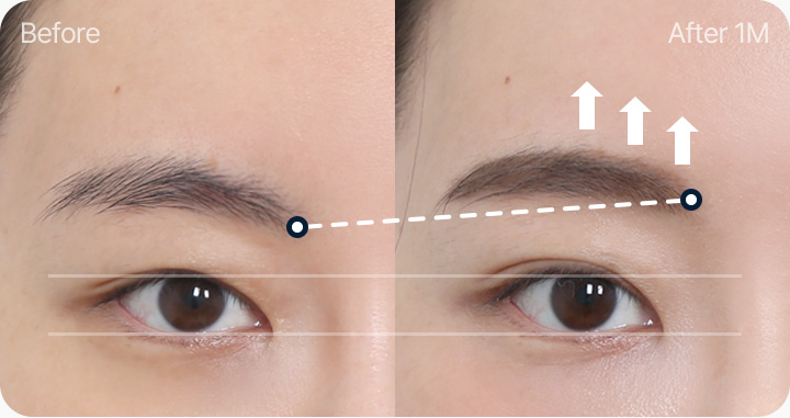 이마거상 전후사진 이마거상후기 처진눈썹 리프팅