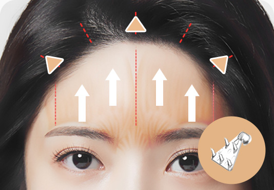 이마거상 수술방법 엔도타인으로 고정