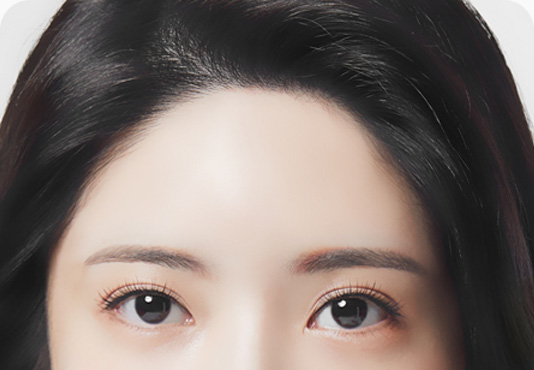 이마거상 수술방법 섬세한 봉합 마무리