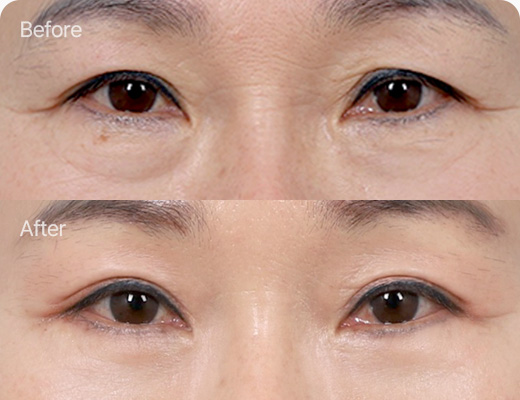 하안검 전후사진 하안검 후기