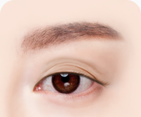 눈썹하거상술 방법 처진 눈꺼풀 피부상태 정밀진단 맞춤 수술 디자인 계획