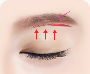 눈썹하거상술 방법 늘어진 근육 리프팅 고정 섬세하게 봉합