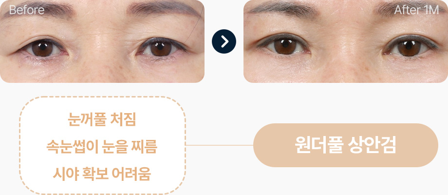 상안검 전후사진 중년상안검 상안검후기 눈꺼풀처짐 속눈썹이 눈을 찌름 시야확보 어려움