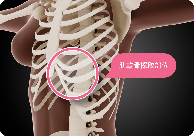늑연골 채취 부위 갈비뼈 아래위치