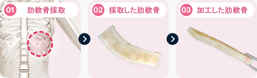 늑연골 채취 채취한 늑연골 다듬은 늑연골