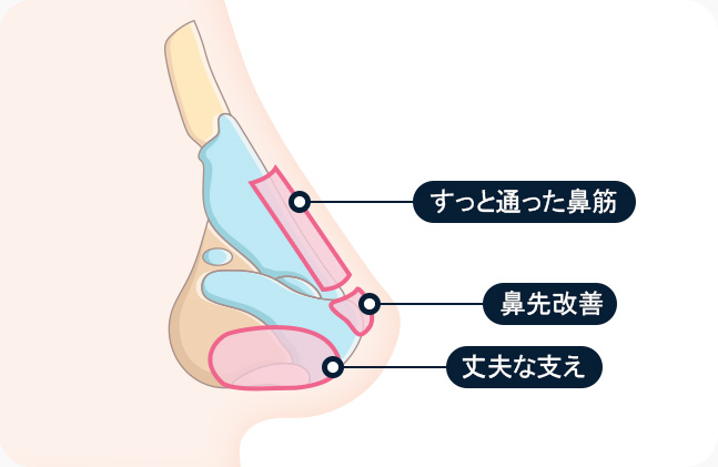 코라인 곧게 뻗은 콧대 코 끝 개선 튼튼한 지지대