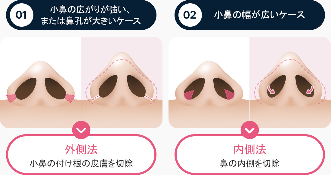 심하게 퍼진 콧날개 큰 콧구멍 외측절개 코 바닥 피부 절제 폭 넓은 콧날개 내측 절개 코 안쪽 절제