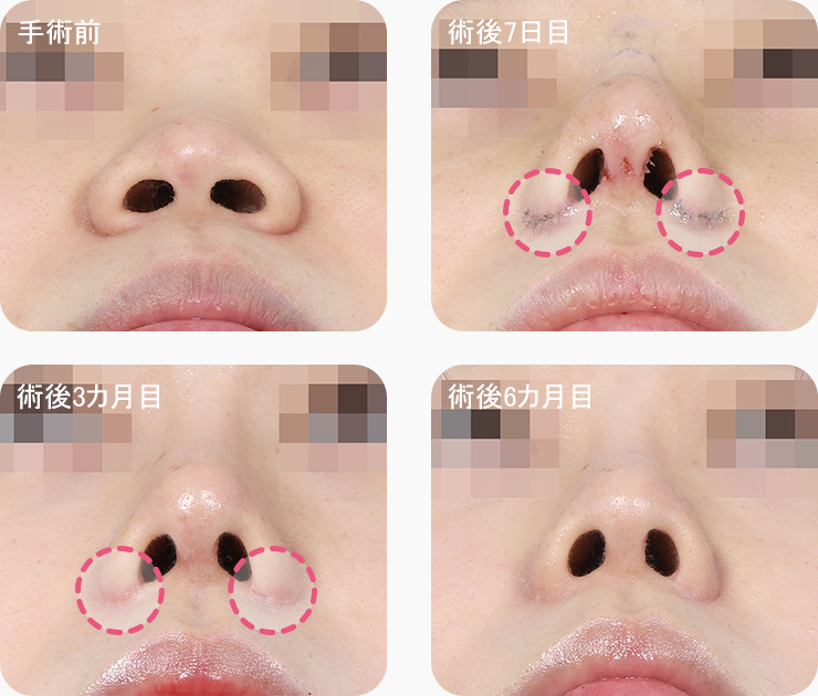 콧볼축소 흉터 경과 수술 1주차 3개월차 6개월차