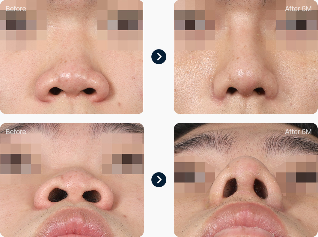 콧볼축소 수술 전후사진