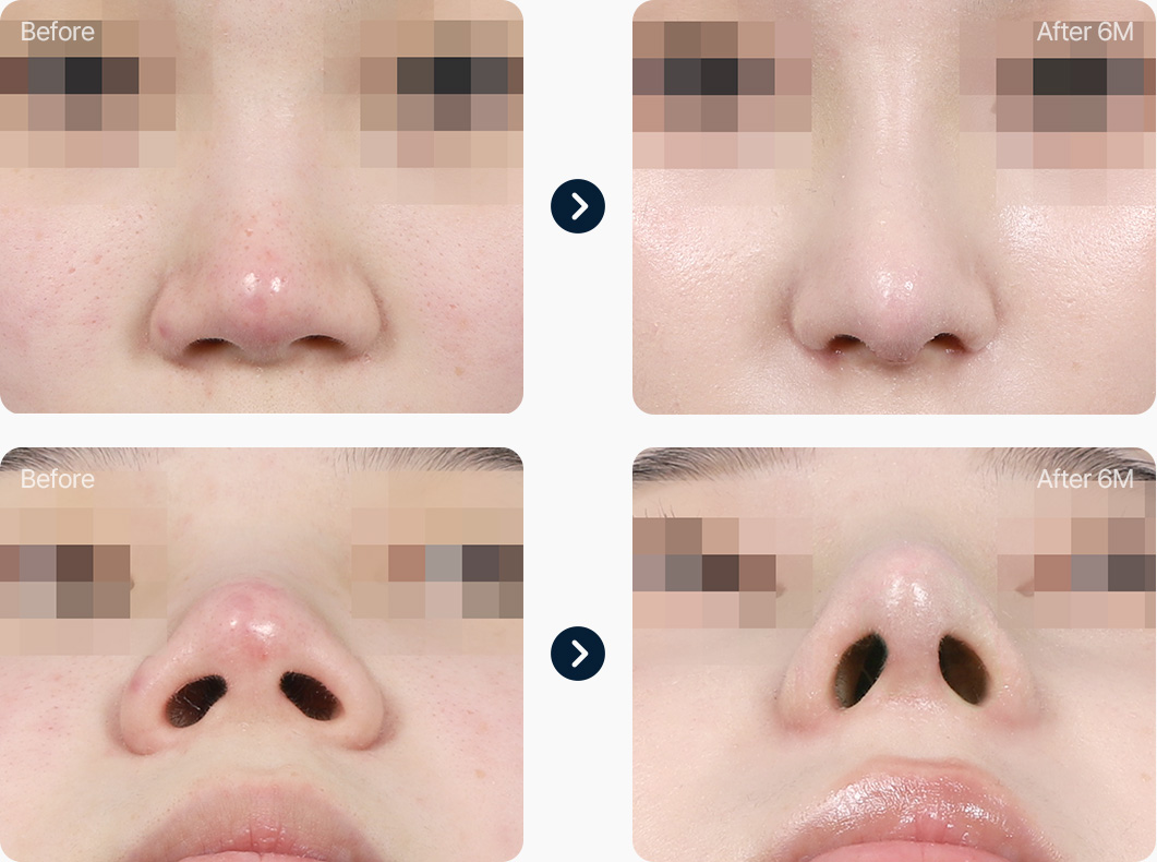 콧볼축소 수술 전후사진