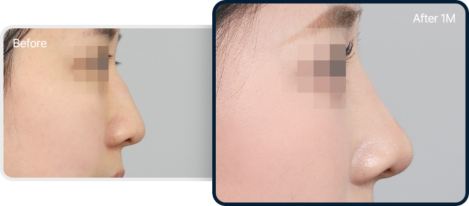 매부리코 성형 전후사진