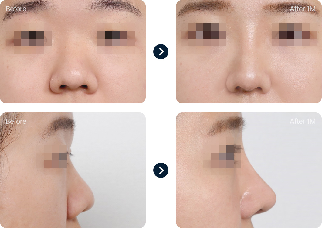 짧은코 들창코 성형 전후사진