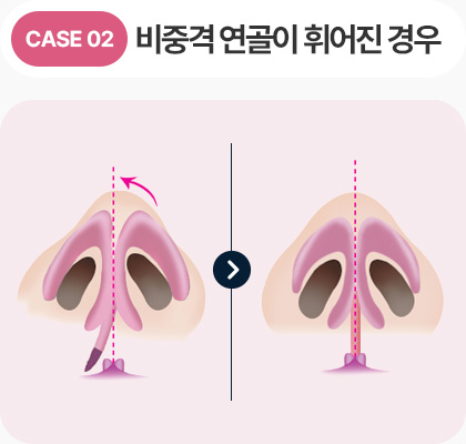 비중격 연골이 휘어진 경우