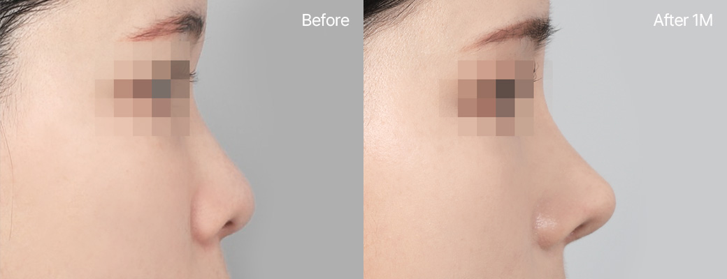 짧은코+들창코성형 기증늑연골 전후사진