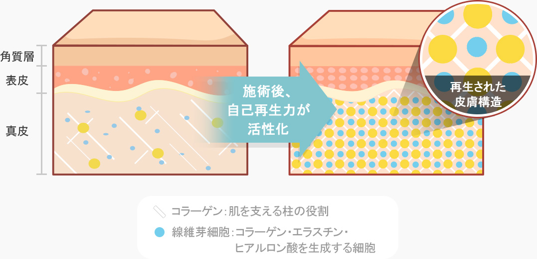 리쥬란 패키지 시술 후 자가 재생능력 활성화 복원된 피부구조