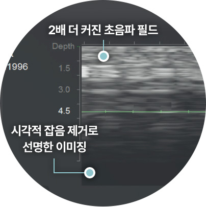 울쎄라 울쎄라피 프라임 울쎄라프라임 실시간 초음파 타켓팅 시술 선명한 이미징